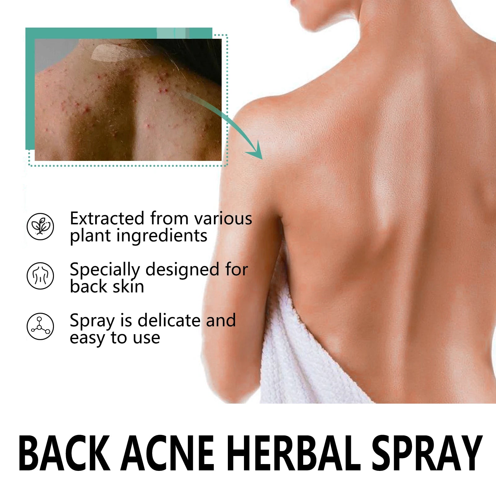 Herbal Acne Remover Spray Back Shoulder Pimple Treatment Blackhead Anti Mites Oil Control Repair Smooth Skin Care Beauty Health