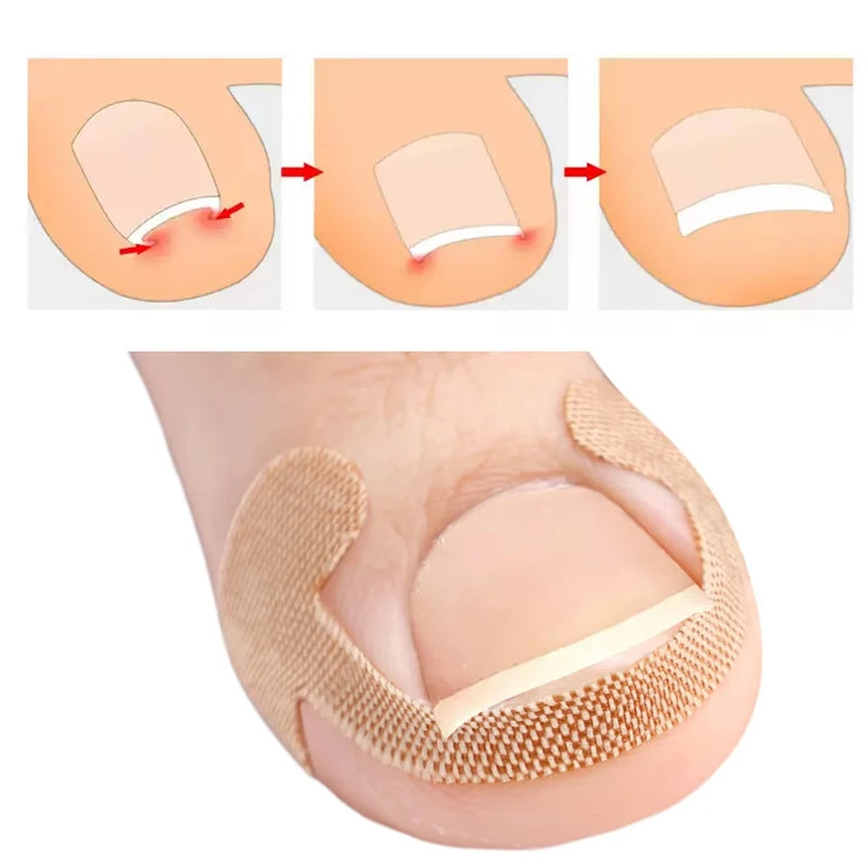 20-100pcs Adhesive Toenail Patch Ingrown Toe Nail Correction Sticker Foot Corrector Pedicure Health Care Tools Toe Treatment Pad