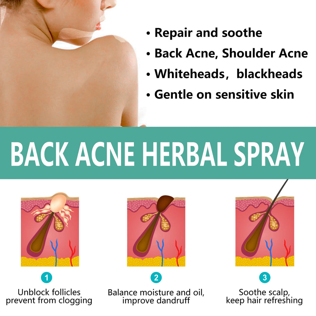 Herbal Acne Remover Spray Back Shoulder Pimple Treatment Blackhead Anti Mites Oil Control Repair Smooth Skin Care Beauty Health