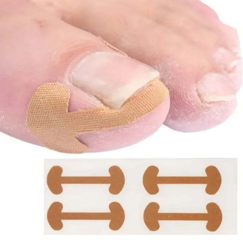 20-100pcs Adhesive Toenail Patch Ingrown Toe Nail Correction Sticker Foot Corrector Pedicure Health Care Tools Toe Treatment Pad
