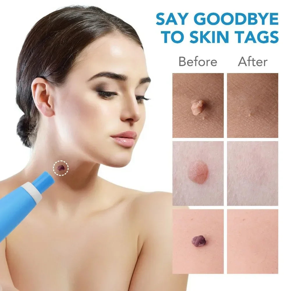 Unisex 2-in-1 Painless Auto Skin Tag & Mole Removal Kit