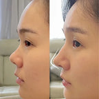 Low Temperature Thermoplastic Board Beauty Fracture Splints High Nose Bridge Reusable Health Care Brace Nasal Shaping Corrector