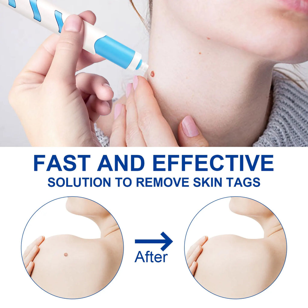 2 In1 Painless Auto Skin Tag Mole Wart Removal Kit Cleaning Tools Face Skin Care Body Wart Dot Treatments Remover Beauty Health
