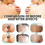 Herbal Acne Remover Spray Back Shoulder Pimple Treatment Blackhead Anti Mites Oil Control Repair Smooth Skin Care Beauty Health