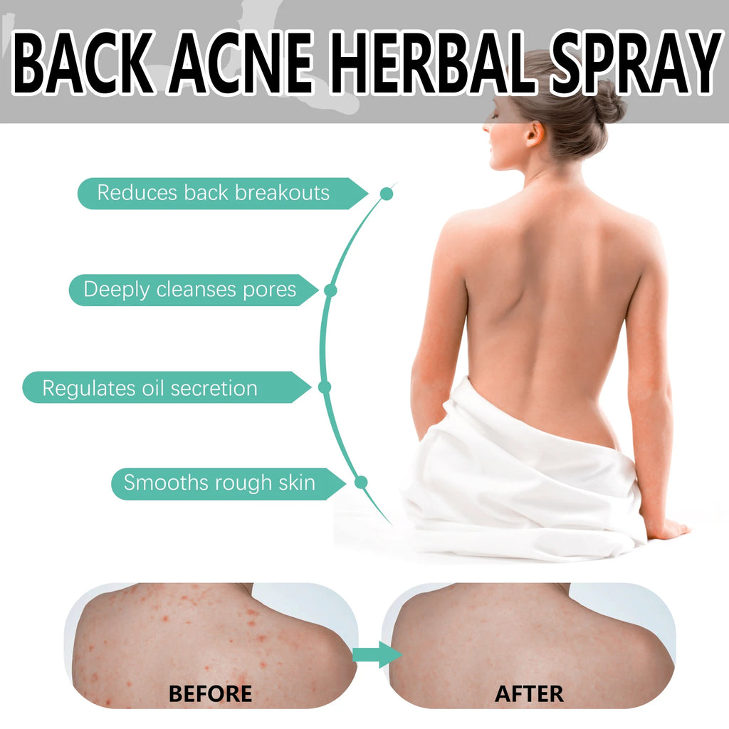 Herbal Acne Remover Spray Back Shoulder Pimple Treatment Blackhead Anti Mites Oil Control Repair Smooth Skin Care Beauty Health