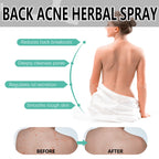 Herbal Acne Remover Spray Back Shoulder Pimple Treatment Blackhead Anti Mites Oil Control Repair Smooth Skin Care Beauty Health
